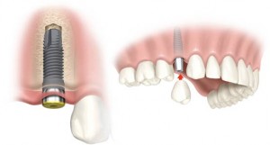 Pret Implant dentar in Iasi la Cabinet stomatologic Anatomic Dent